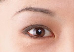 最新2026年版：赤あざのレーザー治療で悩みを解消する完全ガイド